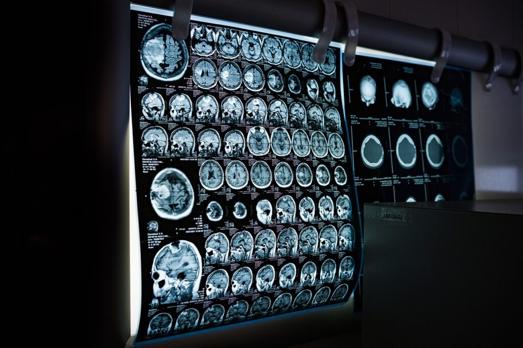 뇌 MRI