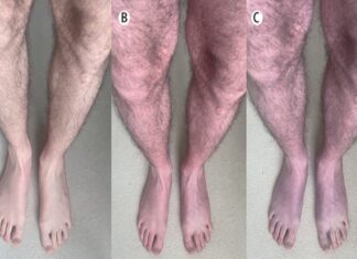 10분 만에 시퍼렇게 변한 다리, 알고보니 ‘코로나 후유증’이었다 푸른 다리 증후군