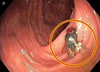 대장내시경 했더니 배속에 살아있는 파리가 ‘위잉’ 대장 파리