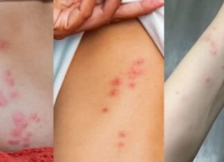 빈대 물린 자국과 모기 물린 자국 구분하는 방법 빈대 물린 자국