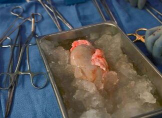 최초로 돼지 신장 이식한 남자, 두 달 뒤 전해진 비보가… 돼지신장이식수술