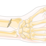 Forearm_fracture_-_Radius_fracture_2_-_Smart-Servier