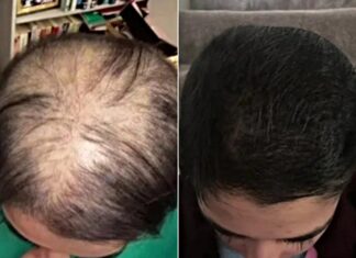 단 6주 만에 탈모 완전 극복한 3가지 비결 탈모