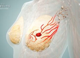 유방암 위험 여성은 ‘이 검사’ 받기만 해도 사망률 낮아진다 유방암