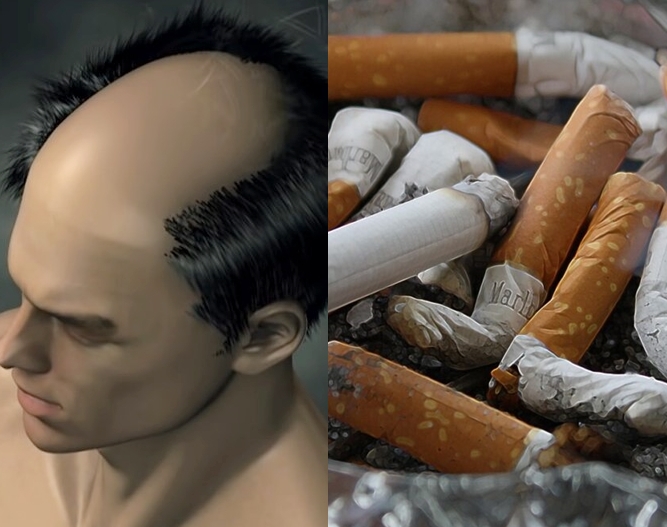 탈모 담배 흡연