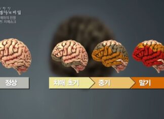 은퇴 후 노년에 치매 가장 잘 걸린다는 직업 치매