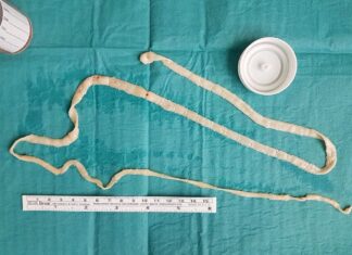 사람 배에서 나온 50cm 기생충…평소 먹은 음식 봤더니 기생충 촌충