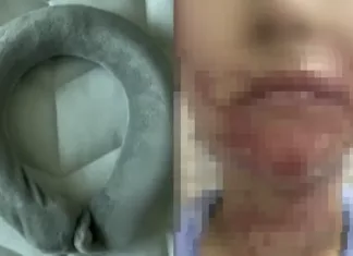 결혼 앞둔 예비신부, 얼굴 화상 입힌 ‘넥 워머’