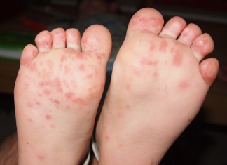 아이들이 겪는 수족구병과 구내염 예방과 관리방법은?