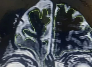 6년간 시달린 만성 콧물, MRI 보니 뇌에서 흐른 뇌척수액이었다