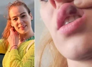 입술 필러 맞았다가 백혈병 진단 받은 30대 여성 사연