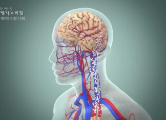 30대에 치매 진단받은 여성, 뒤늦게 밝혀진 진짜 원인은 치매
