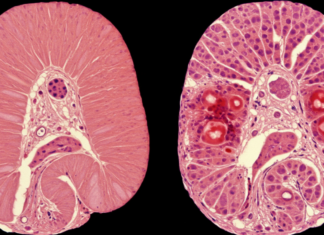 한국인 3명중 1명은 암에 걸린다… 암 사망률 1위는 무엇? 암에 걸리기 전 장기와 함에 걸린 후 장기의 모습