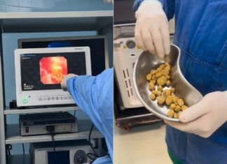 매일 물 대신 콜라 3L 마신 60대 남성 몸에서 나온 것