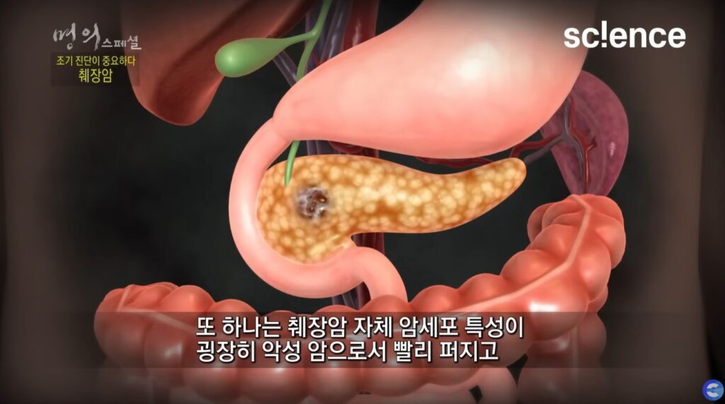 췌장암