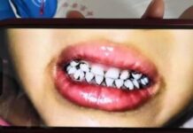 유치원생 70명 집단 납중독…“흰머리 나고 치아 새까맣게 변해”