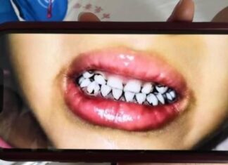 유치원생 70명 집단 납중독…“흰머리 나고 치아 새까맣게 변해”