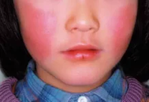 뺨 맞은 줄…일본 오키나와에 쫙 퍼진 ‘사과병’ 환자 사진 사과병