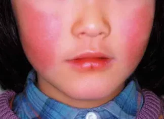 뺨 맞은 줄…일본 오키나와에 쫙 퍼진 ‘사과병’ 환자 사진 사과병