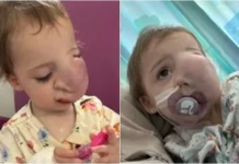 병원 데려갔다가 아동학대로 의심받은 아기 얼굴