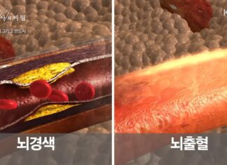 ‘골든타임 4시간 반’ 뇌졸중 전조 증상 5가지 뇌졸중