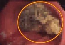 “덩어리가 위 막아” 20대 여성, ‘이것’ 먹었다가 결국 수술