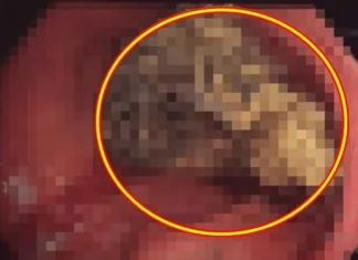 “덩어리가 위 막아” 20대 여성, ‘이것’ 먹었다가 결국 수술